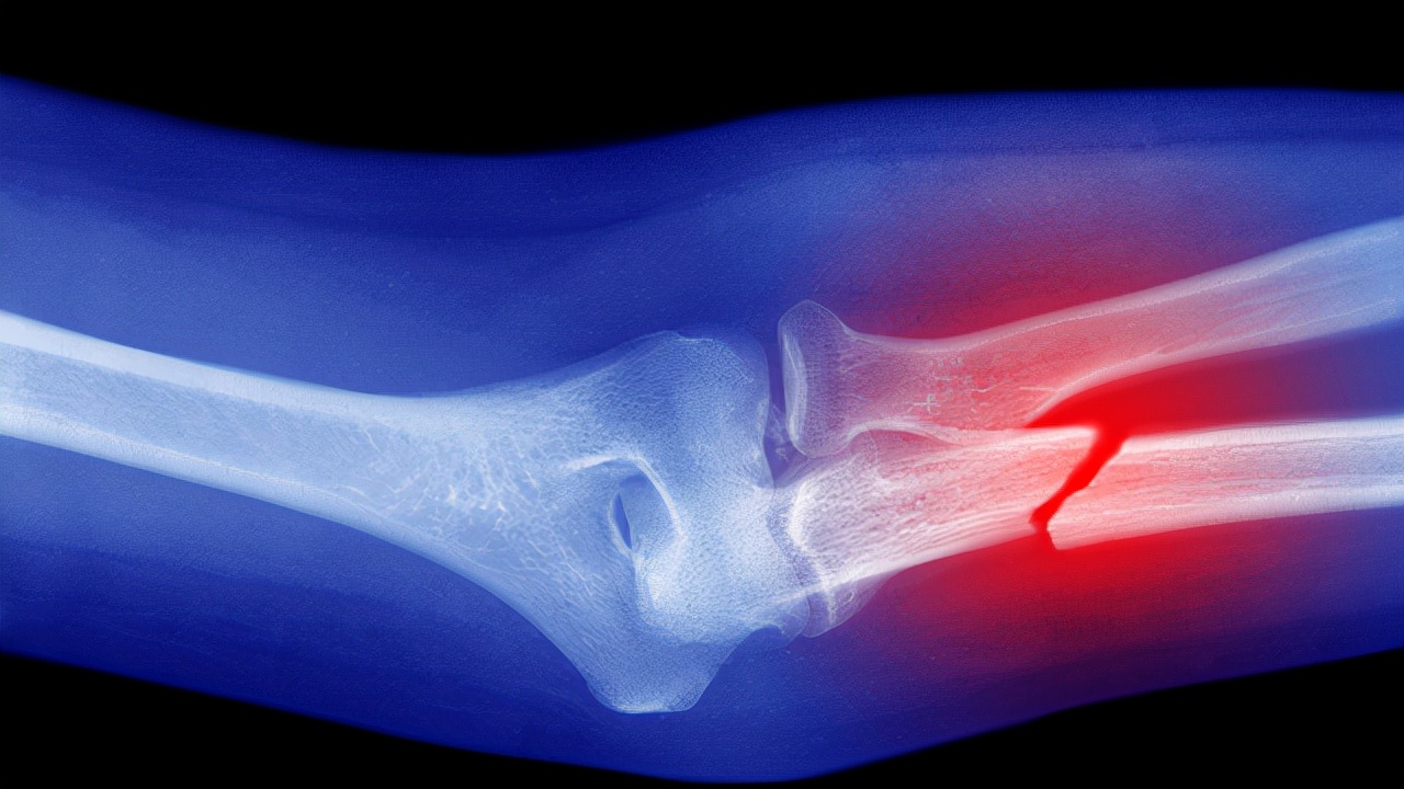 骨折后骨质疏松吃什么食物补得快,骨折的病人补钙哪种食物效果最好