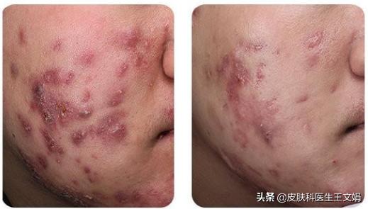 伴随一生的皮肤病,伴随一身的皮肤病有哪些