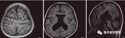 脑室为什么会扩张,脑室为什么会变小