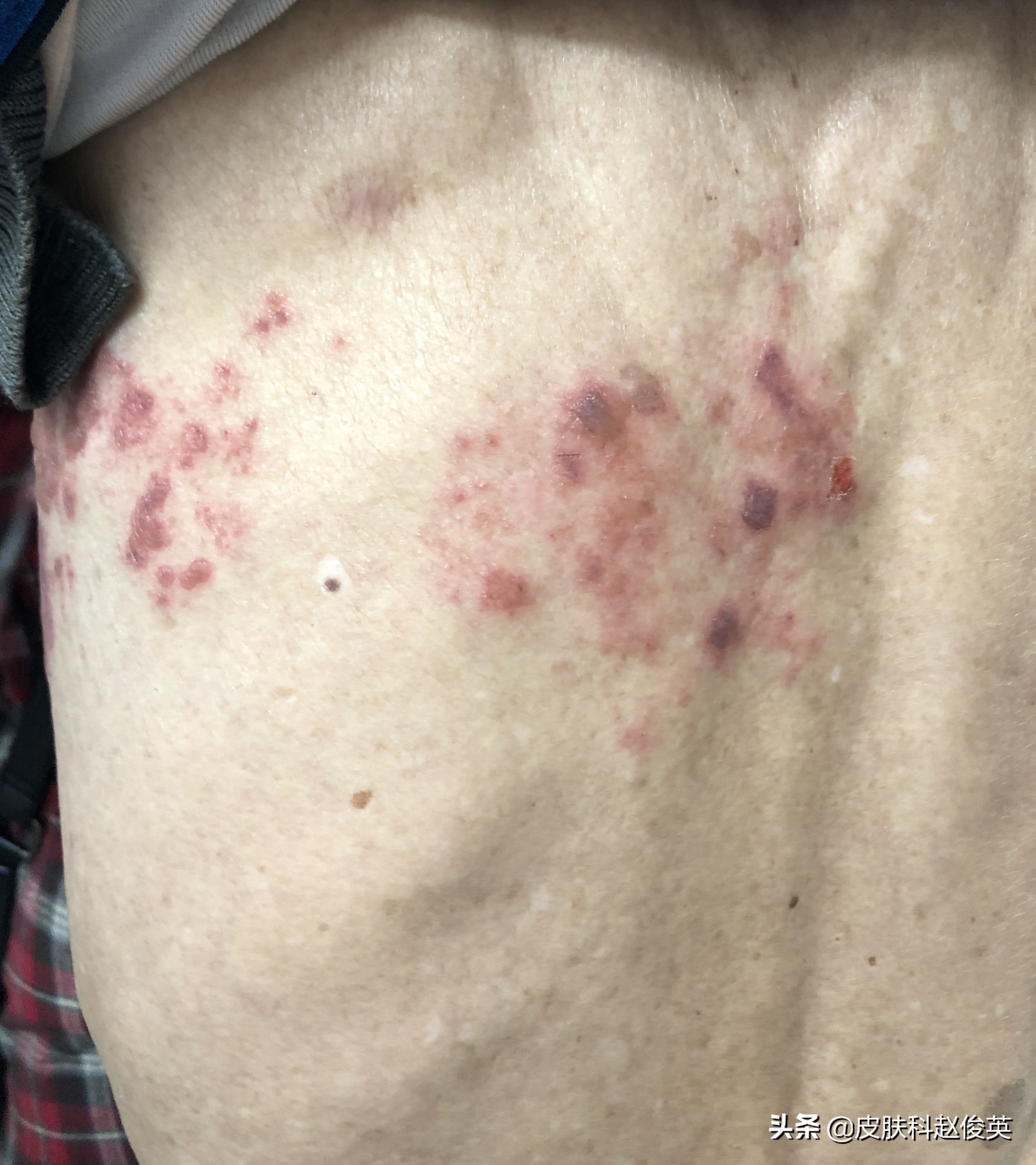 最近带状疱疹高发期,年轻人得带状疱疹是不是都有大病