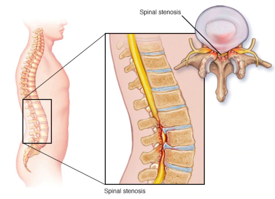 腰腿痛走路可以缓解是什么病,腰椎管狭窄腿疼晚上为啥疼得厉害