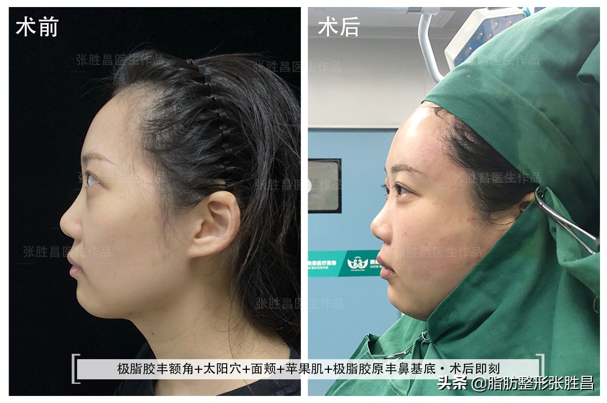 30岁龅牙矫正牙齿后脸型变化图,牙齿矫正使脸型凹陷会恢复吗