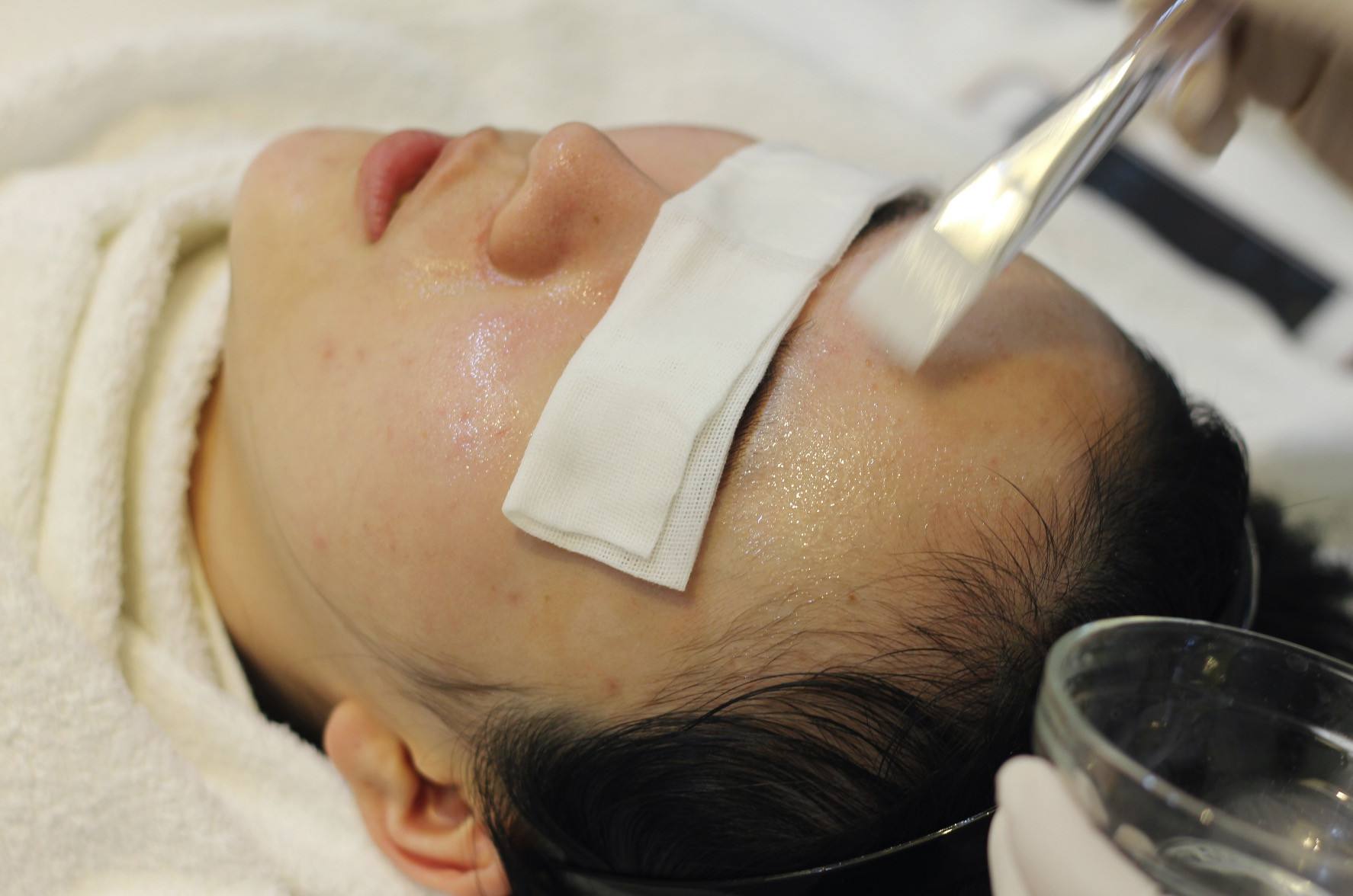 光子嫩肤做了多久可以做果酸换肤，真的能让毛孔收敛吗？