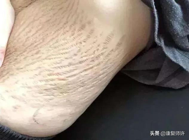 产后腹直肌分离恢复瘦肚子训练,产后腹直肌分离恢复的最佳方法