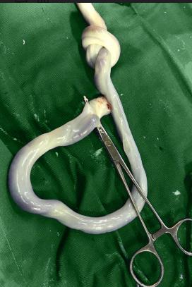 胎儿附属物胎盘、胎膜、脐带、羊水的形成与功能，你知道吗？