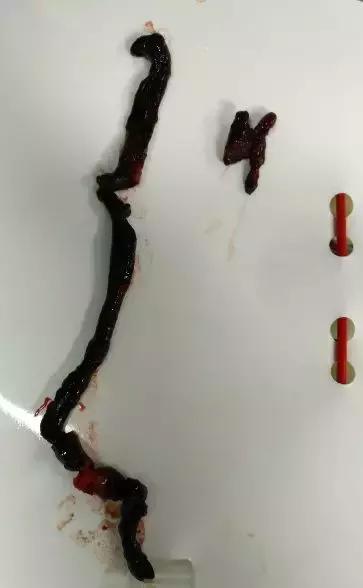 小腿血栓皮肤溃烂创面怎么处理,皮肤血管坏死怎么回事