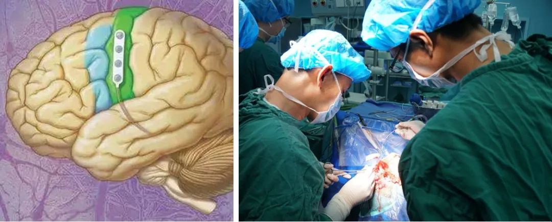 坐骨神经痛是糖尿病引起的吗,被糖尿病并发症吓到