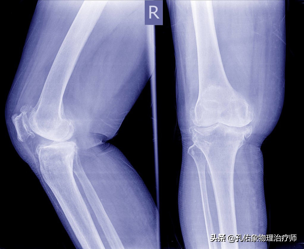 膝关节炎怎么解决疼痛,膝关节骨性关节炎最新的治疗方法