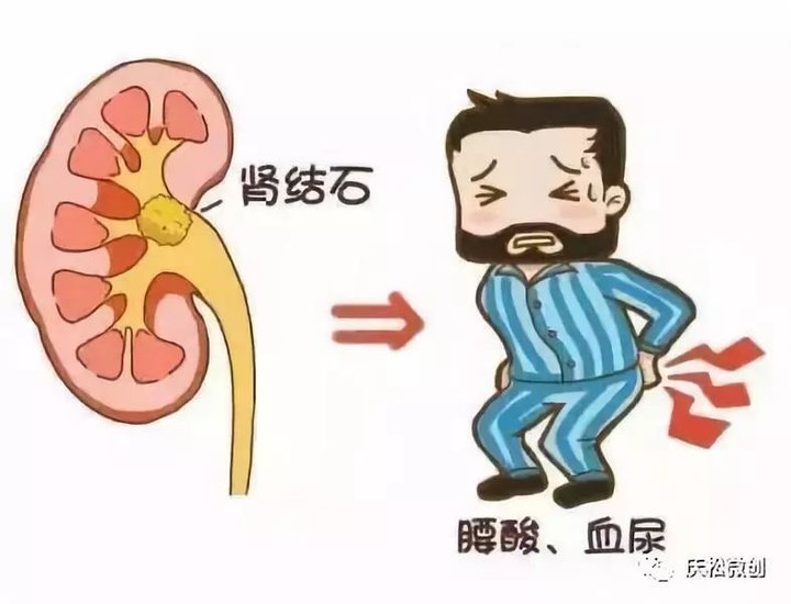 肾结石的治疗最好的方法有几种,肾结石治疗有什么好的方法