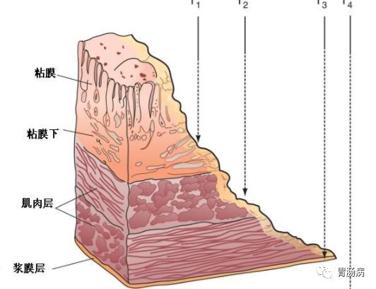 这10类人容易得胃癌，消化科医生告诉你怎么筛查