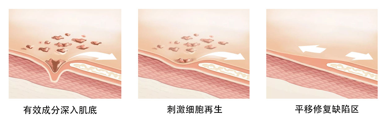 皮肤美容激光术后护理｜科普篇