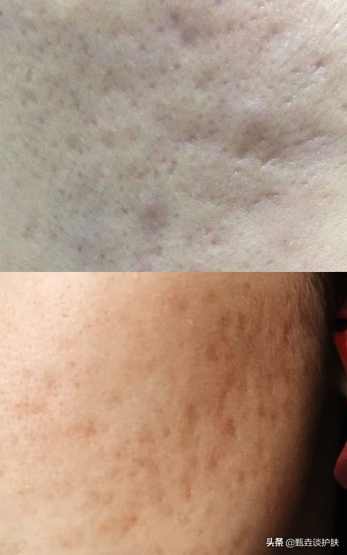 脸上小痘坑怎么修复,痘坑到底能不能修复