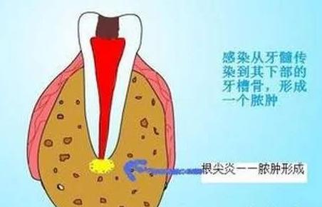 牙齿反复发炎,吃药也没用!该怎么治疗才好?
