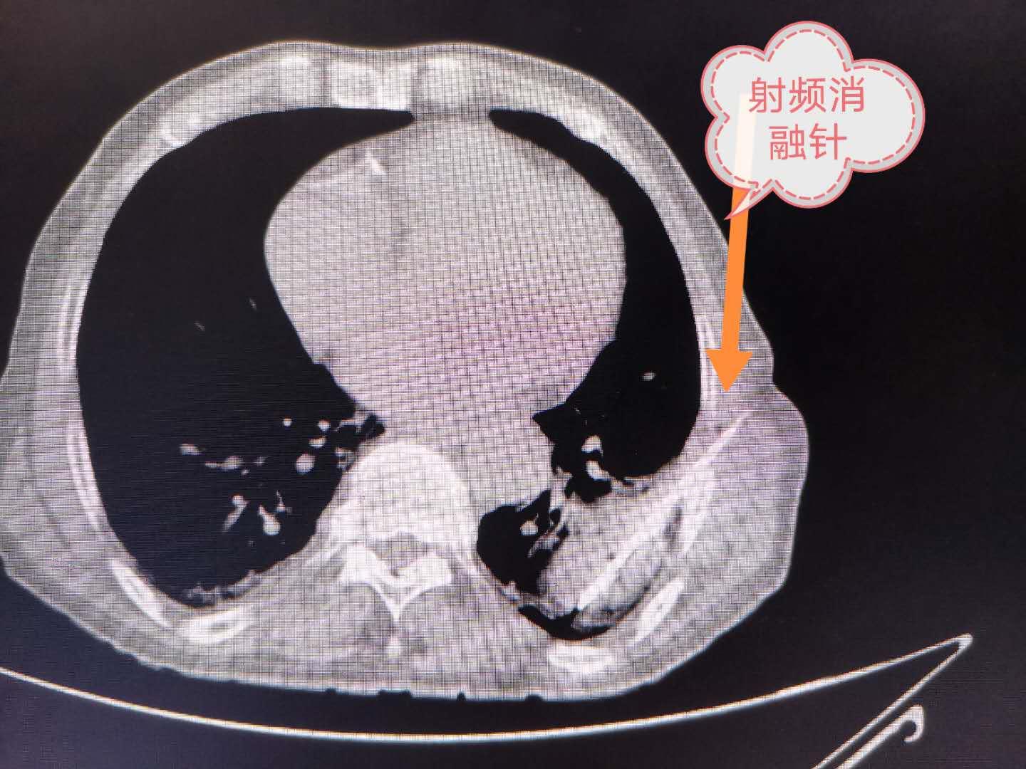 老人肺癌胸疼,外科王医生肺癌