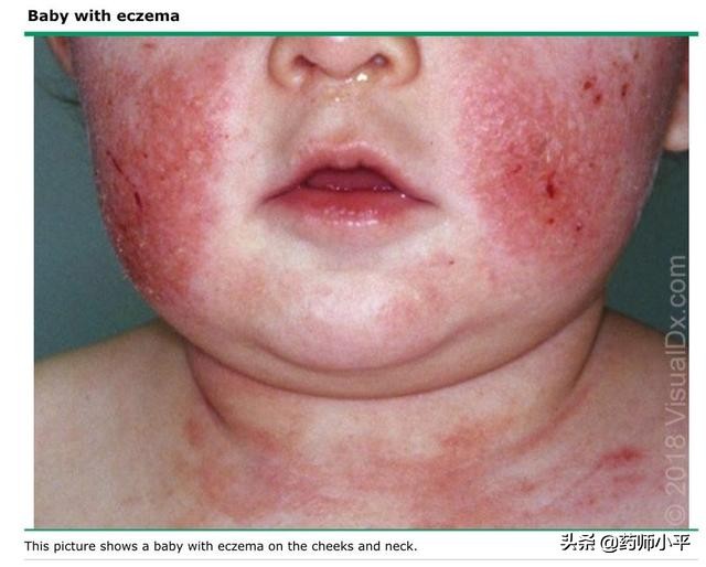宝宝湿疹妈妈应注意哪些,宝宝湿疹反复妈妈要一直忌口吗