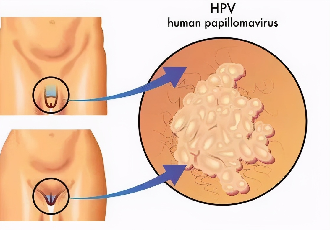 尖锐湿疣的早期症状是什么
