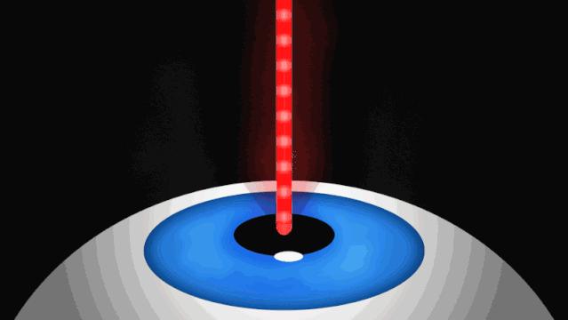 ICL近视手术全知道！术前术中术后全攻略