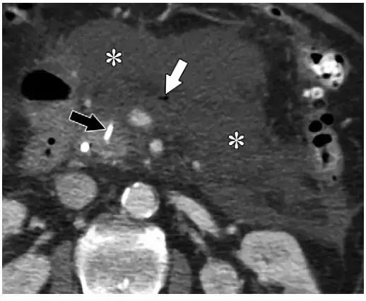 急性胰腺炎影像检查首选,急性坏死胰腺炎影像