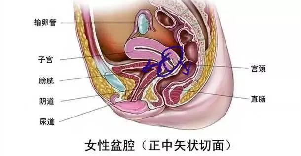 当女人膀胱、宫颈、直肠被癌症强行“打通”以后会是什么后果?