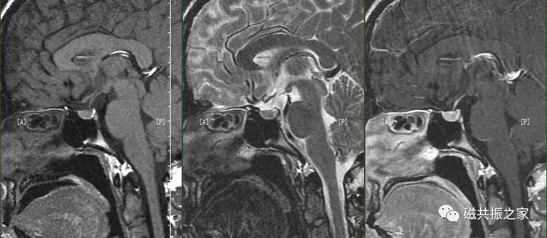 垂体mri扫描,垂体微腺瘤mri扫描