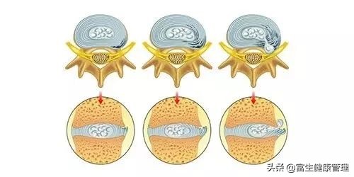 腰痛这种仅次于感冒的第二大常见病症，这些事你不可不知
