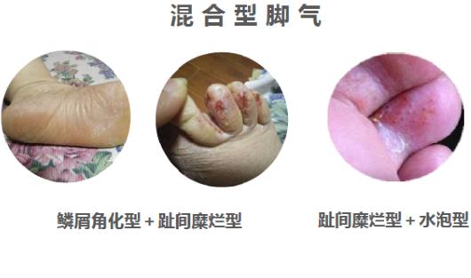 远离真菌,验方治愈一切真菌感染皮肤病