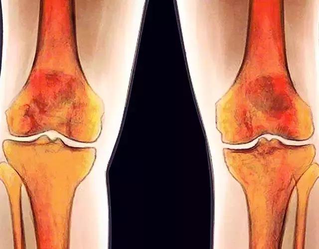 膝关节置管术和膝关节置换修补术,膝关节置换与全膝关节置换的区别