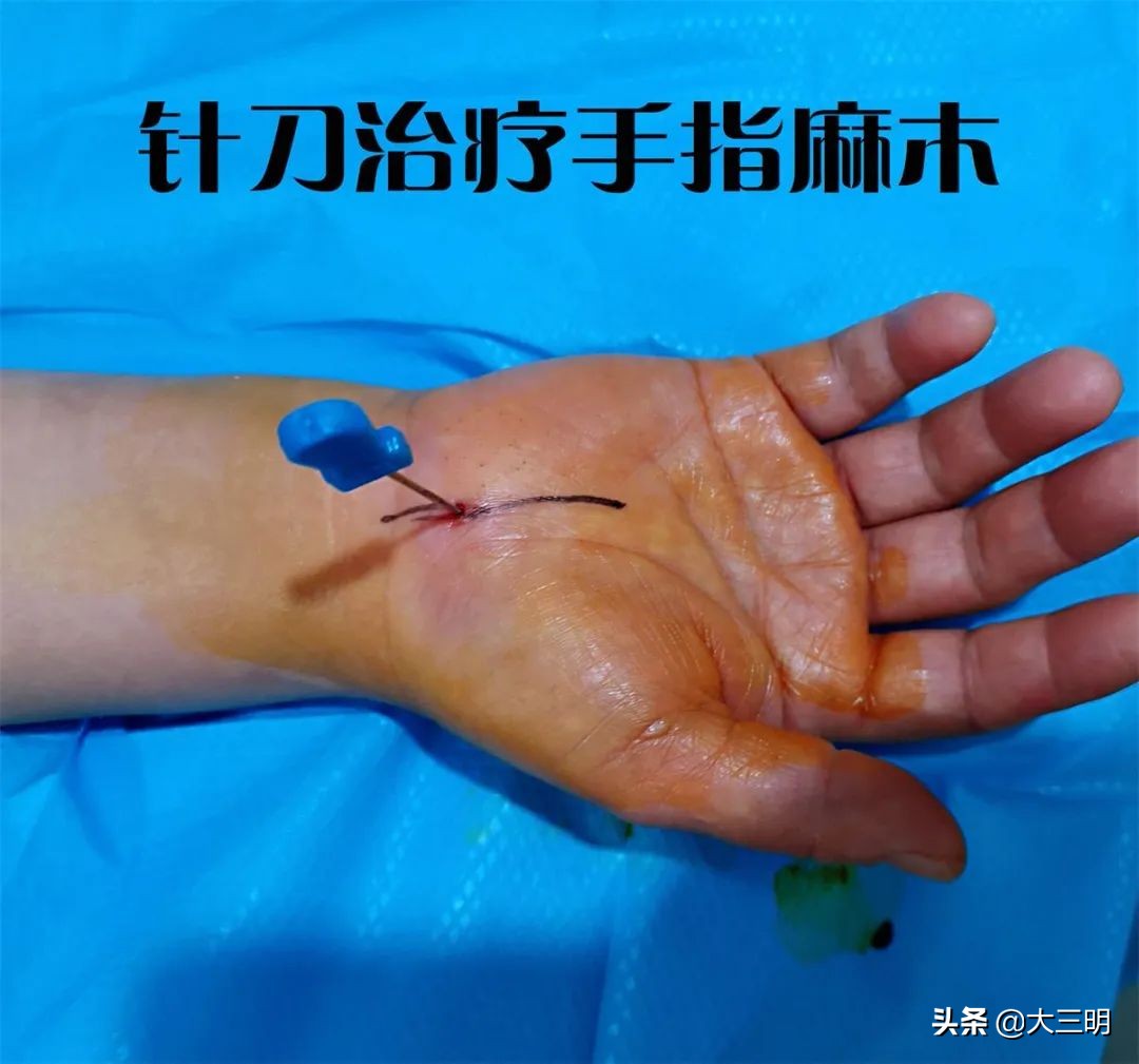 顽固性网球肘的敲打治疗,网球肘针刀效果怎么样