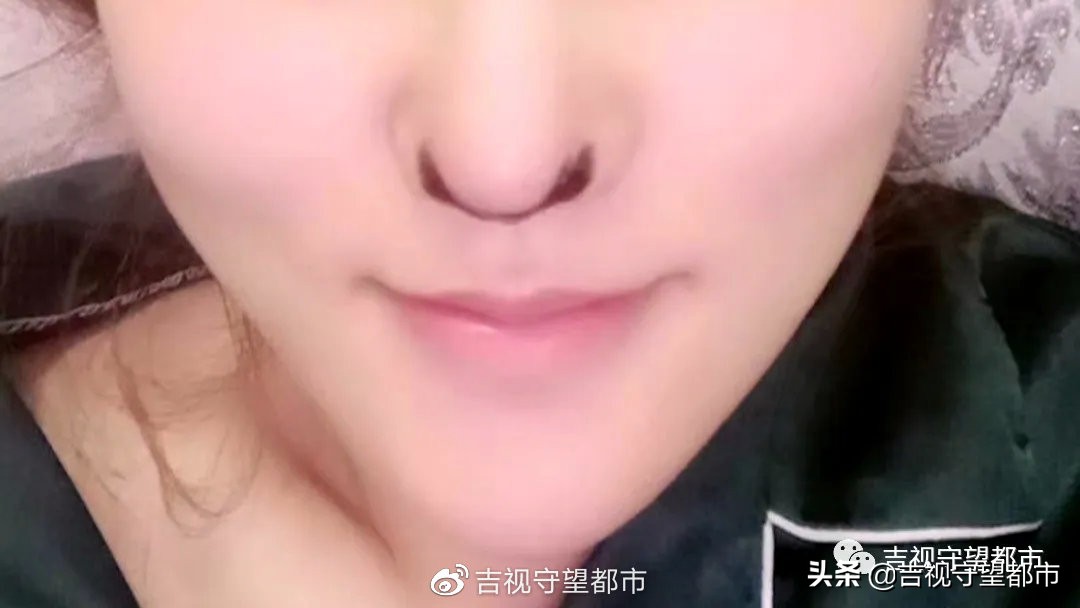 隆鼻疤痕萎缩,女子隆鼻手术后鼻子变黑