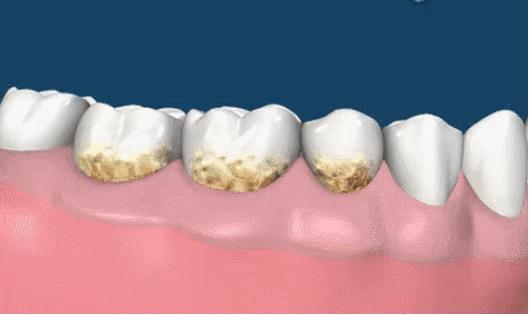 草莓籽在嘴里发了芽？刷牙少了这一步，你真的只是刷了个寂寞