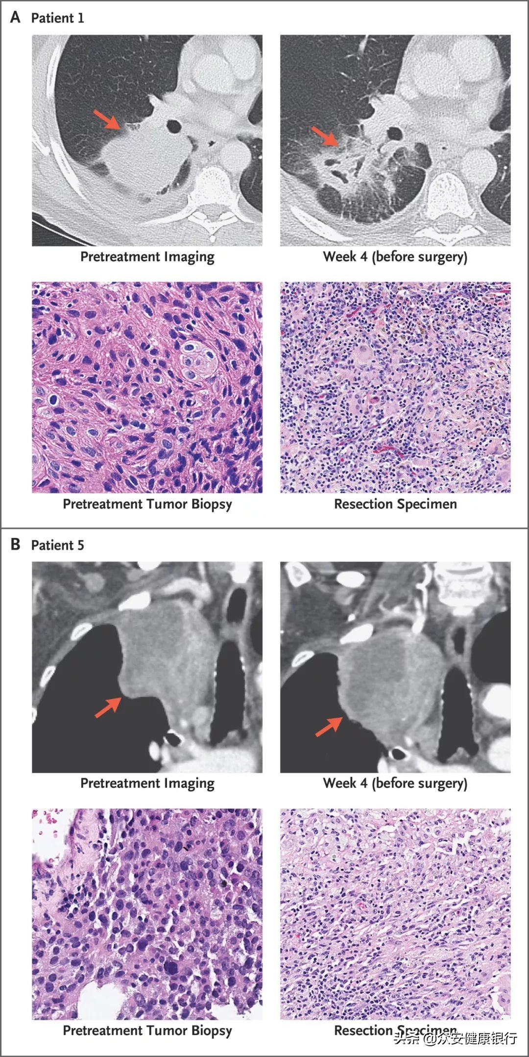免疫治疗早期肺癌的效果如何,免疫治疗晚期肺癌的治愈率