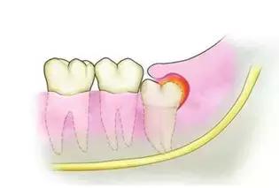 水平阻生智齿一定要拔掉吗,嘴里长了智齿一定要拔掉吗