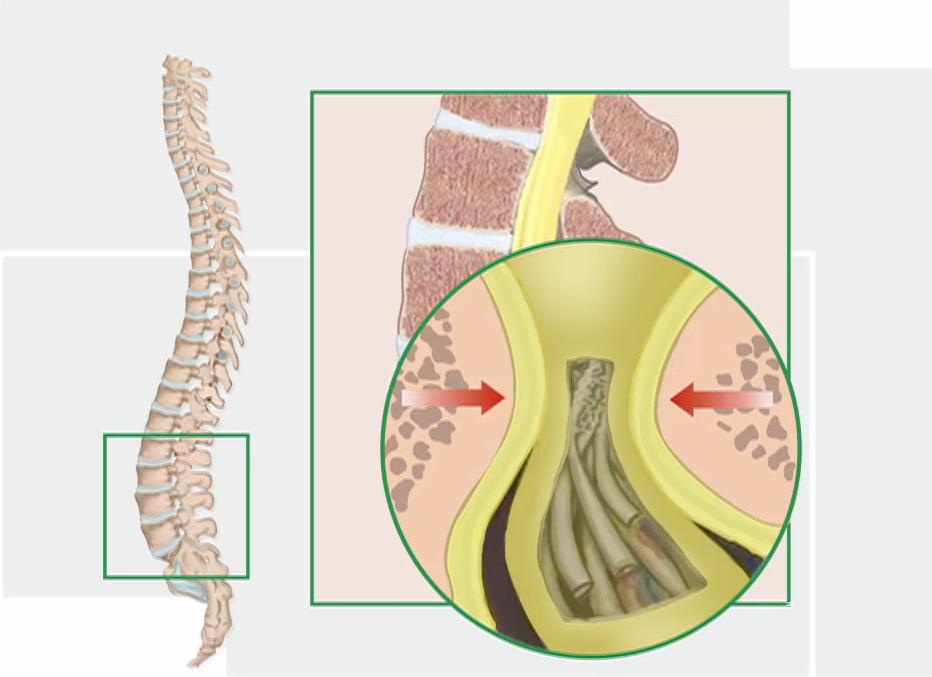 间歇性跛行就一定是腰椎管狭窄吗,间歇性跛行走路一瘸一拐