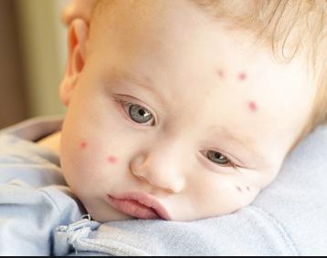 日本叮叮无比滴驱蚊止痒液,日本驱蚊止痒婴儿专用