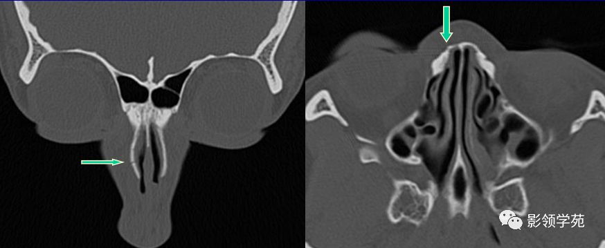 鼻骨影像学解剖,鼻骨解剖及骨折影像学诊断