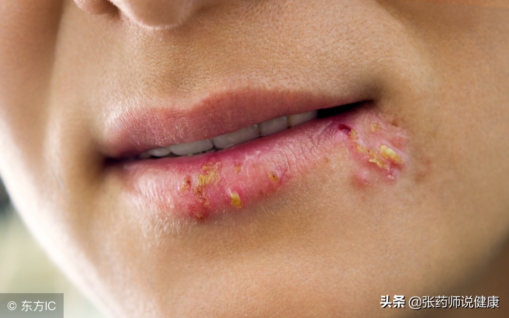 嘴唇发炎怎样治疗,嘴唇发炎怎么改善