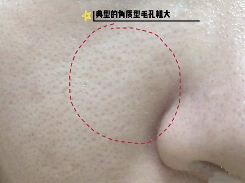 油皮毛孔粗大洗面奶,油皮毛孔粗大怎么补水