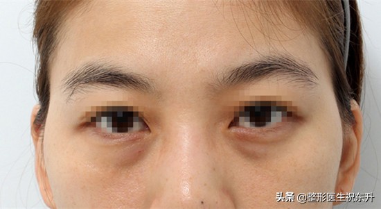 “祛眼袋”这件事,您试过几种妙招?说实话“还是手术靠谱”