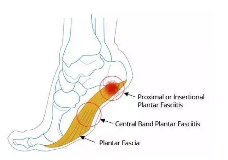 足底筋膜炎疼痛怎么处理,足底筋膜炎疼痛难忍怎么办