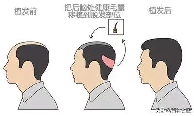 脱发自救神器,脱发自救指南电子书