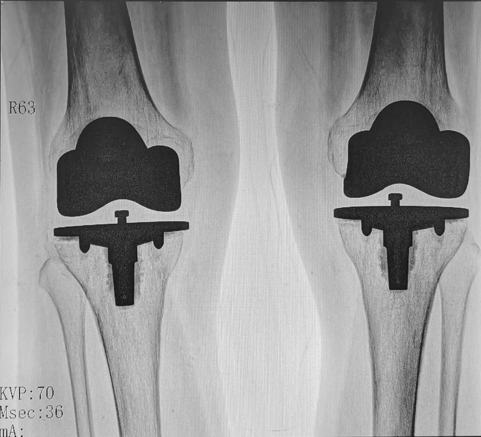 膝关节骨性关节炎诊断及治疗,膝关节骨性关节炎症状及治疗