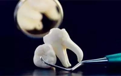 江湖无痛拔牙方法,真正的无痛拔牙