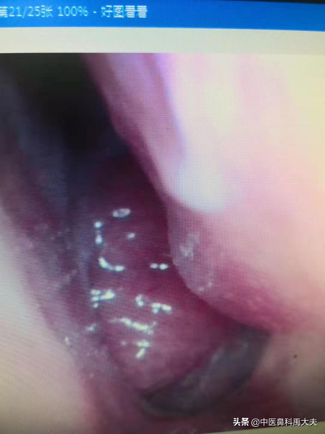 腺样体肥大是什么样子的,怎样是腺样体肥大面容