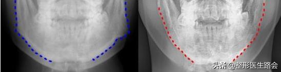 蘑菇怎么变成鹅蛋脸,国字脸磨骨成瓜子脸多少钱