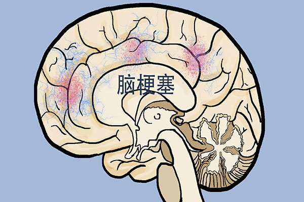 轻度脑梗要注意哪些,轻度脑梗前兆打什么药