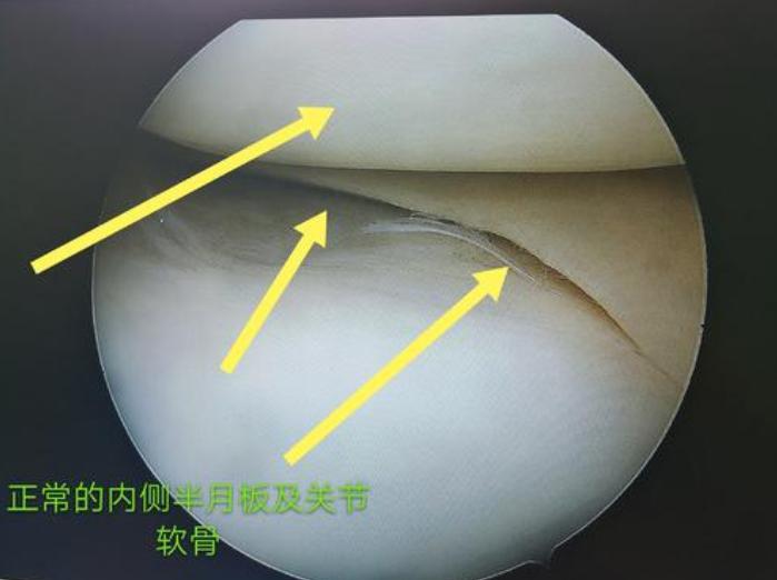腿弯膝盖疼痛怎么治疗最好,腿膝盖疼的最佳锻炼方法