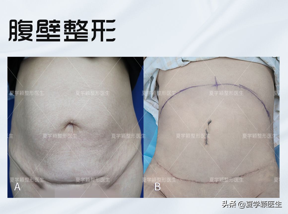腹壁成形和剖腹产哪个手术更大,产后多久可以做腹壁成形手术