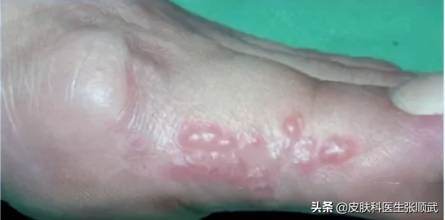 手上小水泡汗疱疹,脚上手上起小水泡很痒可以根治吗