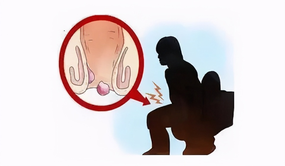 发现肛门口有软软的肉块，究竟是什么？