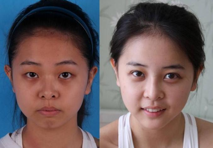 激光美白小妙招,激光美白哪种效果最好